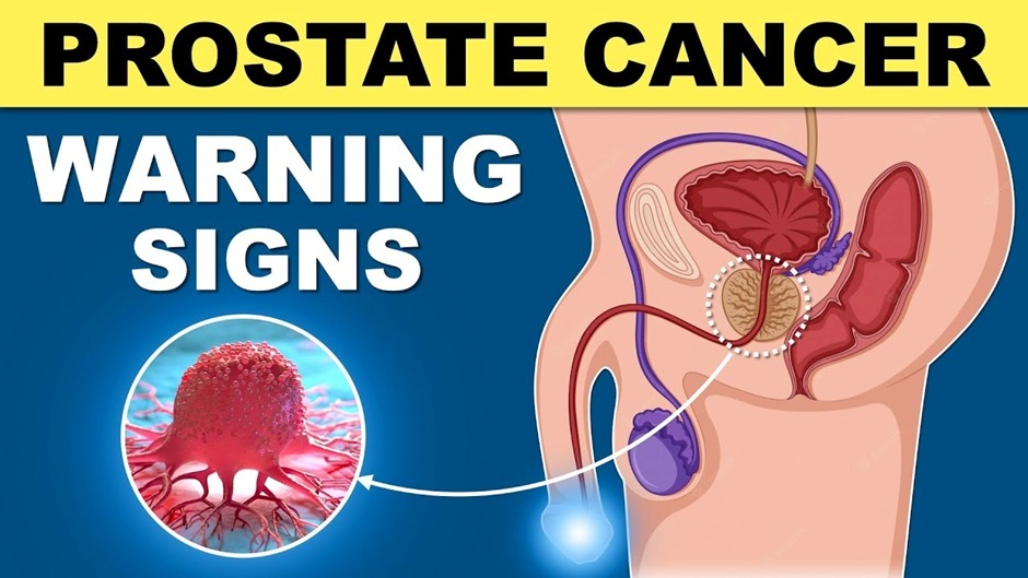 Prostate Cancer Treatment in Meerut