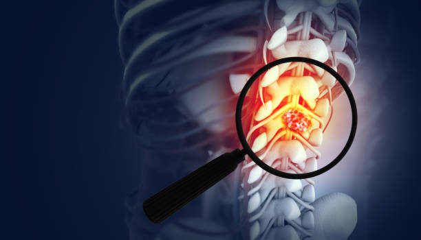 Best Treatment for Spine Tumor in UP