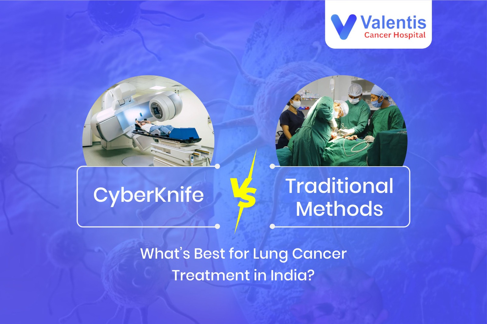 Lung Cancer Treatment in India