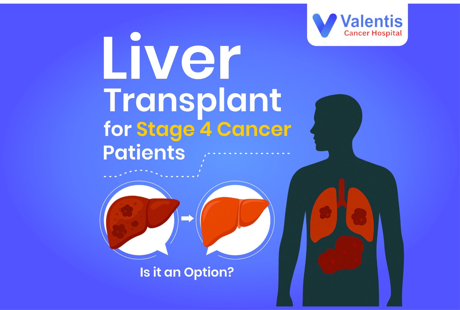 Liver cancer 4th stage treatment
