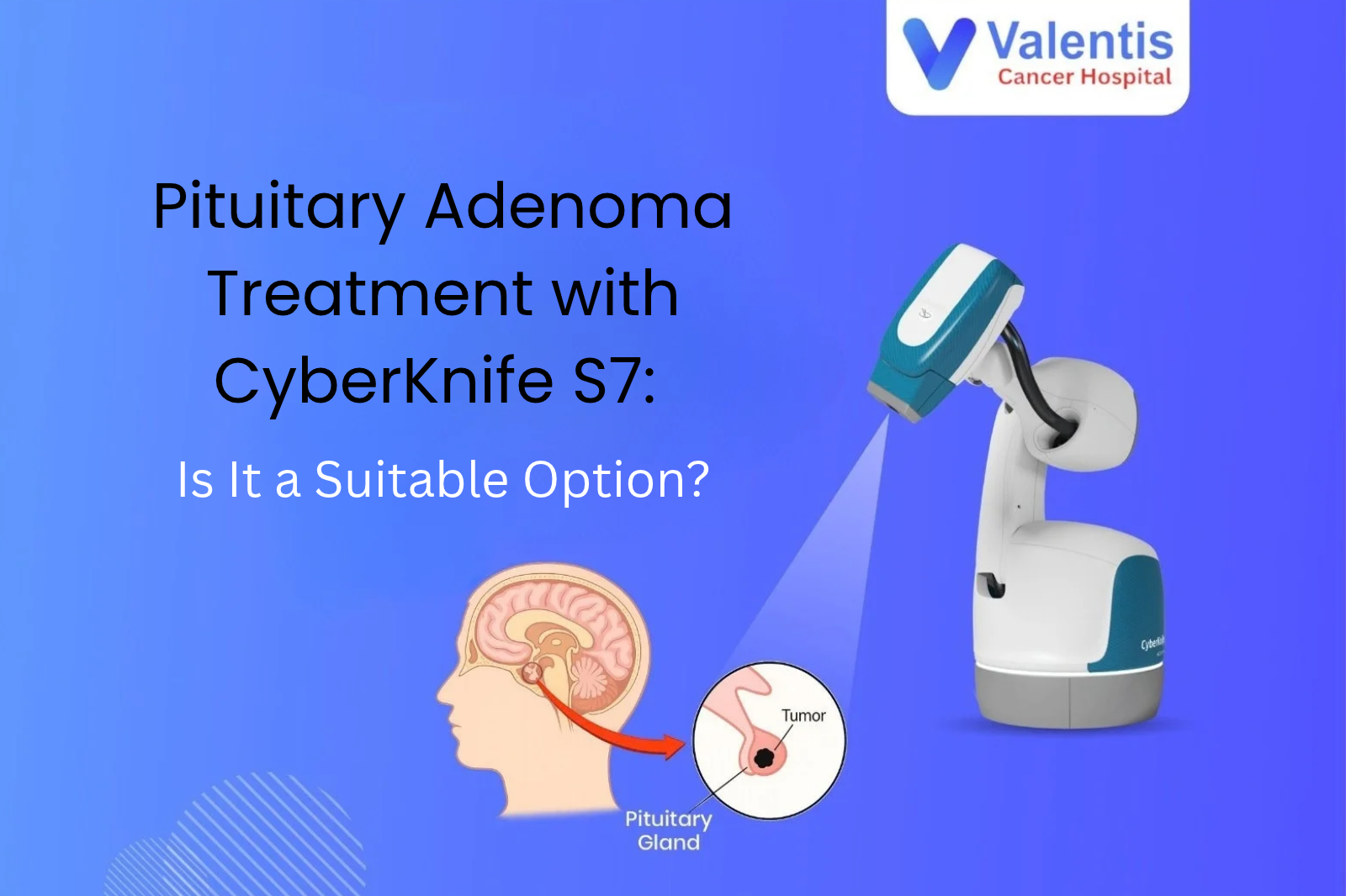 Pituitary Adenoma Treatment with CyberKnife S7: Is It a Suitable Option?